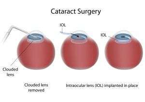 illustration of cataract surgery