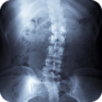 x-ray image of a spine with scoliosis