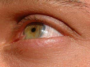 pink tissue growth on left eye