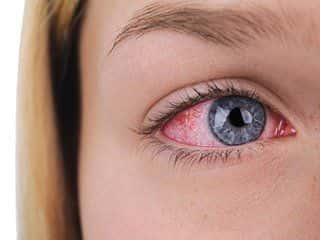 Image of a girl with pink eye.