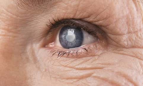 Older woman with glaucoma