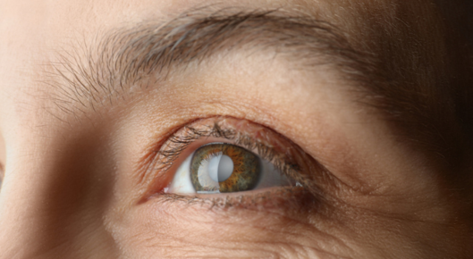 Old woman's cataract