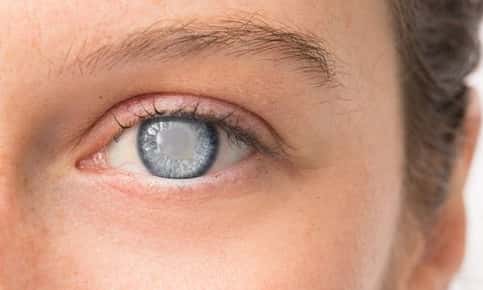 Girl with cataract