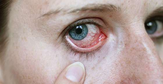 Image of a swollen eye. 