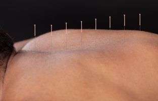 image of person receiving acupuncture. 