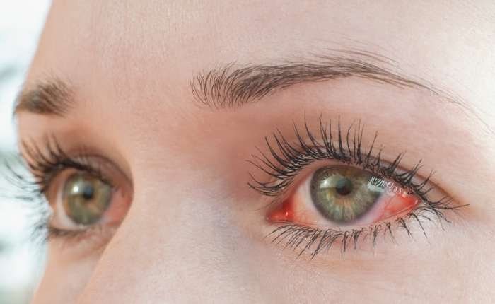 Close up of woman's infected eyes.