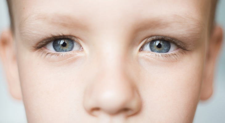 Strabismus or Crossed Eyes - College of Optometrists in Vision