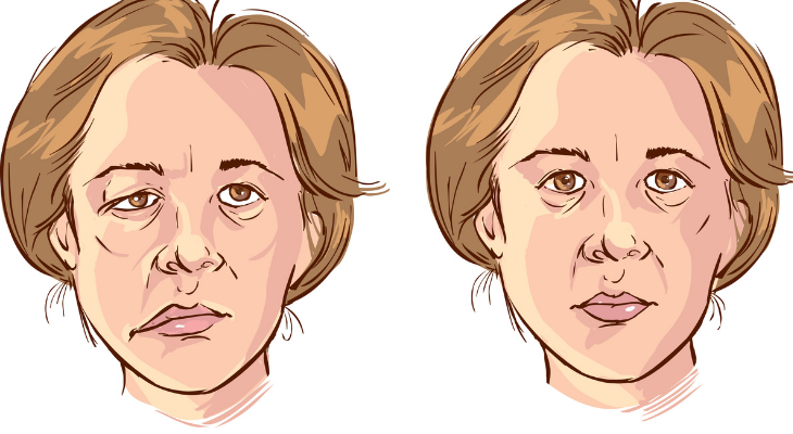 Bell's palsy