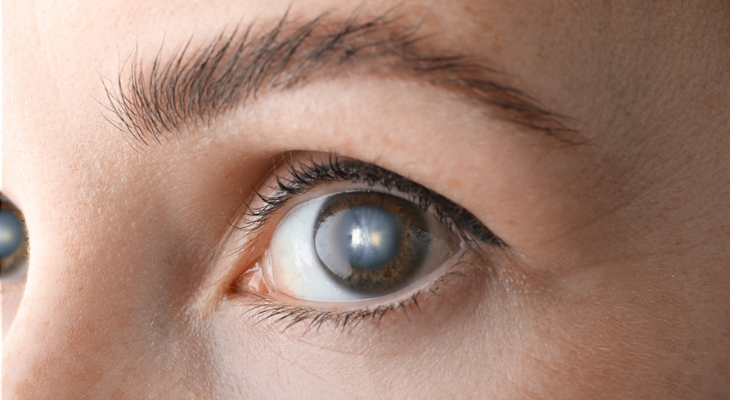 Woman with cataracts.