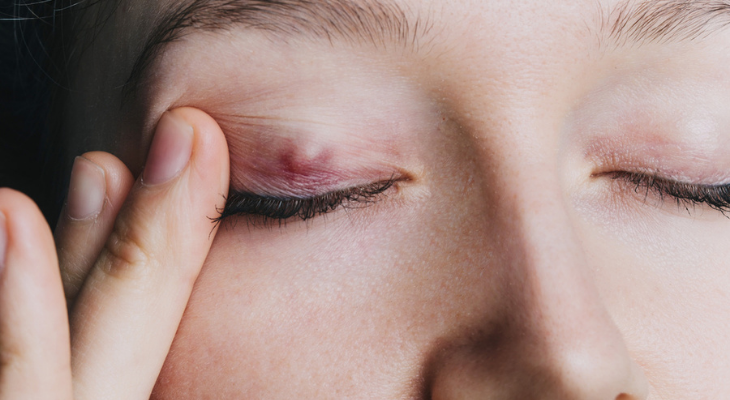 Woman with chalazion on eye