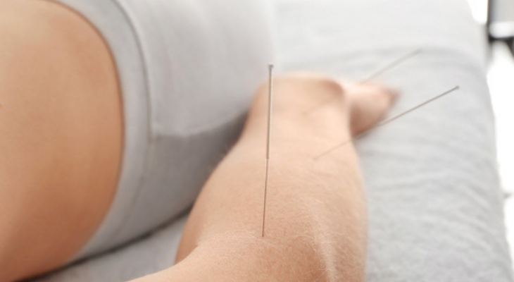 Acupuncture in arm