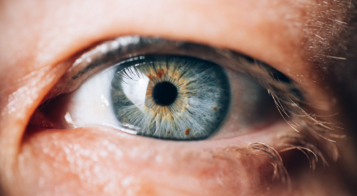 Woman with eye freckles