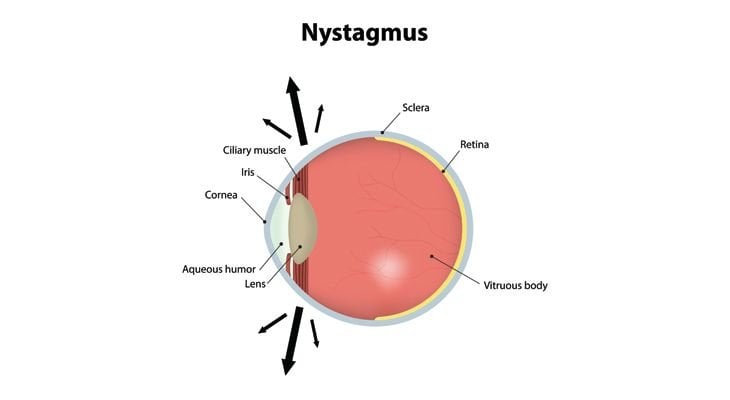 nystagmus