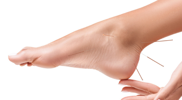 Acupuncture in foot