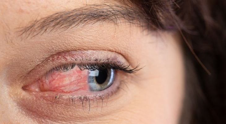 ocular rosacea