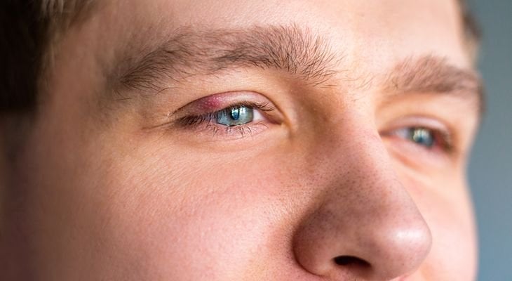 What Is a Stye (Sty) in the Eye?