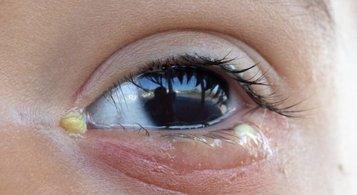 How to Get Rid of Puffy Eyes  Will Vision and Lasik Centers