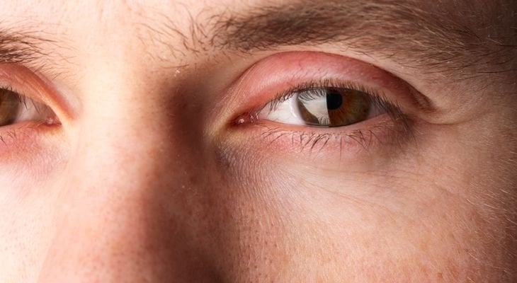 swollen-eyelids-optometrist-in-jackson-ca-sierra-eyecare-associates