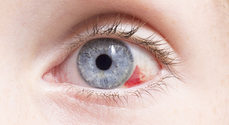 Broken blood vessel in eye