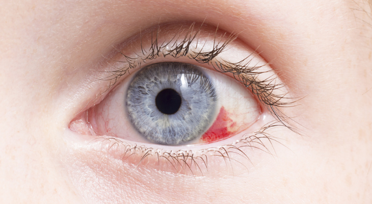 What A Broken Blood Vessel Means For Your Eye Ophthalmologist In 