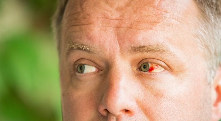 subconjunctival-hemorrhage-optometrist-in-accomac-va-accomac