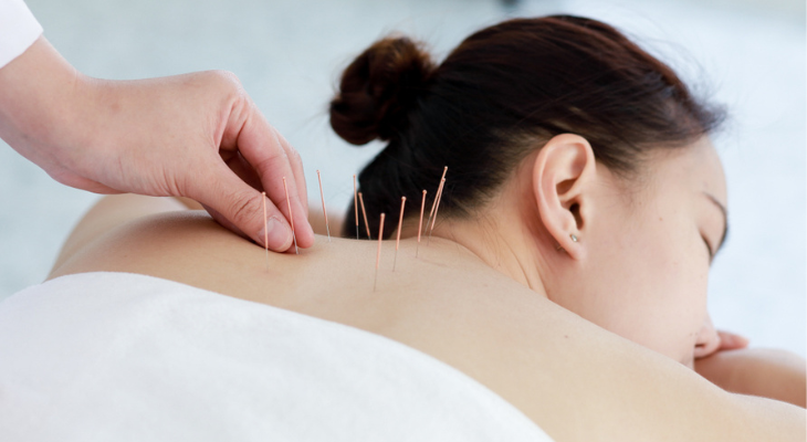 Woman receiving acupuncture treatment