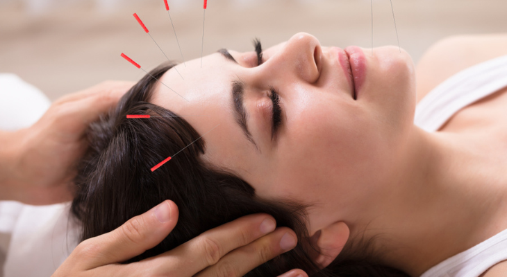 Woman receives facial acupuncture