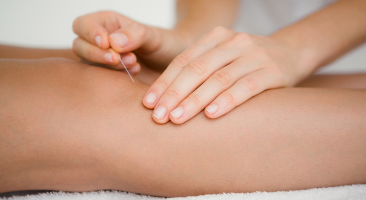 Person getting acupuncture in knee