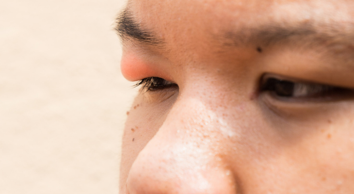 Puffy Eyes: the Causes and How to Get Rid of Them