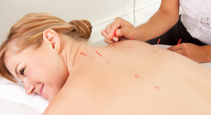 Woman receives acupuncture for her breathing problem.