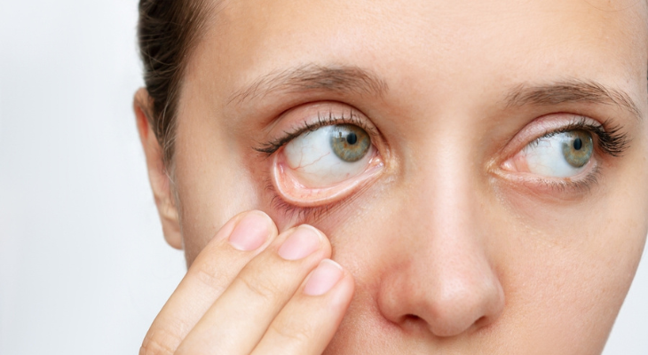 Woman with anemia experience eye trouble.