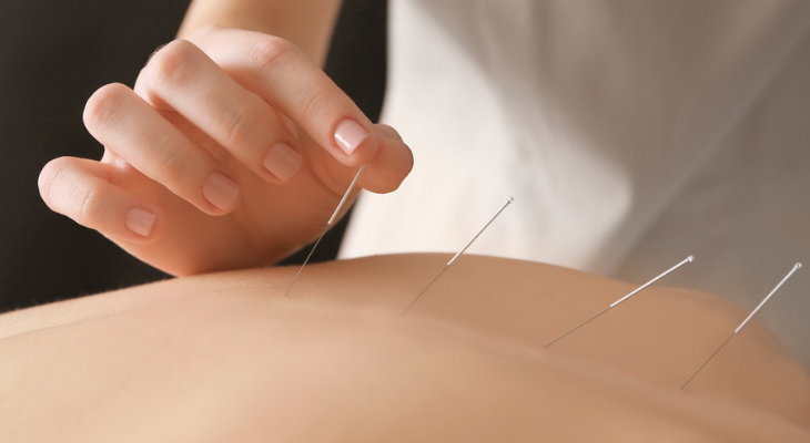 Closeup of acupuncture