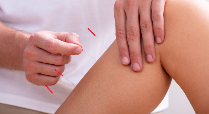 Acupuncture on leg