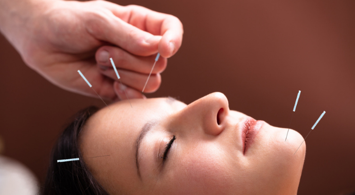 Acupuncture in face