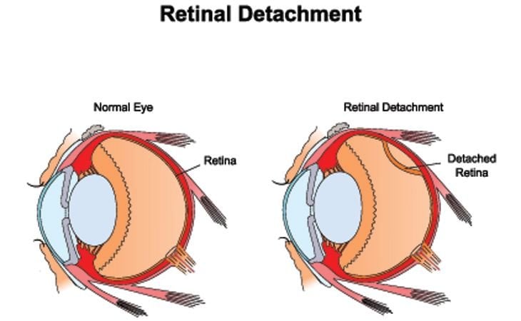 Detached Retina, Optometrist in Chicago, Illinois