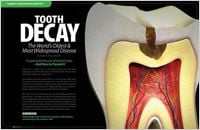 Tooth Decay - Dear Doctor Magazine