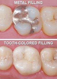 Metal fillings vs tooth-colored fillings.