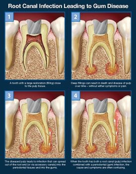 Root canal infection leading to gum disease.