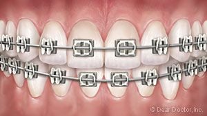 Metal braces.