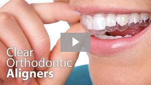 Clear Orthodontic Aligners Video