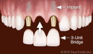 Dental Implants Replace Multiple Teeth.