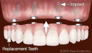 Dental Implants Replace All Teeth.