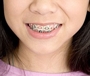 Adolescent orthodontic care.