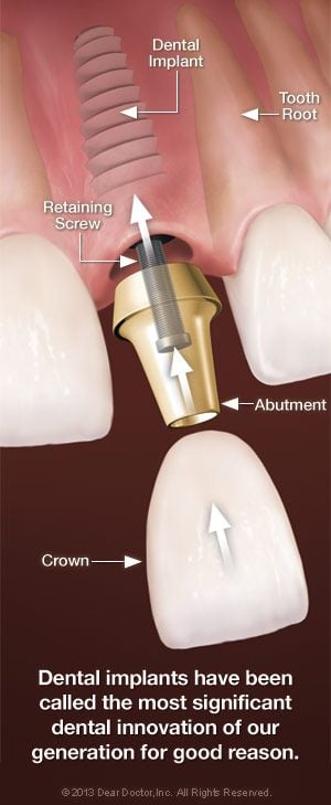 Dental implant components.