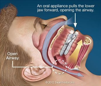Oral Appliance Therapy.