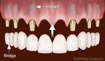Implant supported fixed bridge.