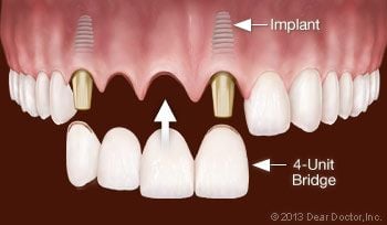 Replacing Multiple Teeth With Dental Implants.