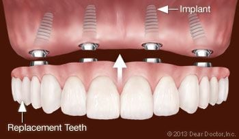 Replacing all teeth with dental implants.