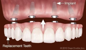 Replacing all teeth with dental implants.