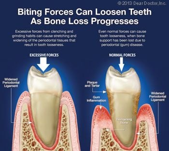 Biting forces can loosen teeth as bone loss progresses.
